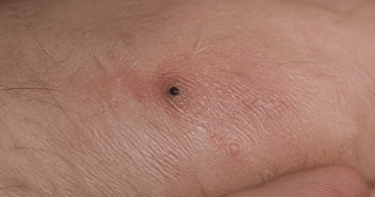Partie noire de parasite enfoncee profondement dans epidermis humaine