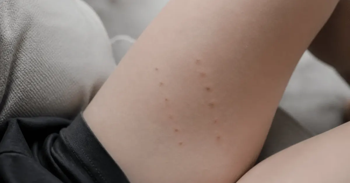 Deux rangées de petites piqûres rouges sur peau blanche
