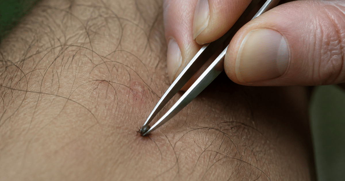 Pince a epiler retirant parasite de la peau