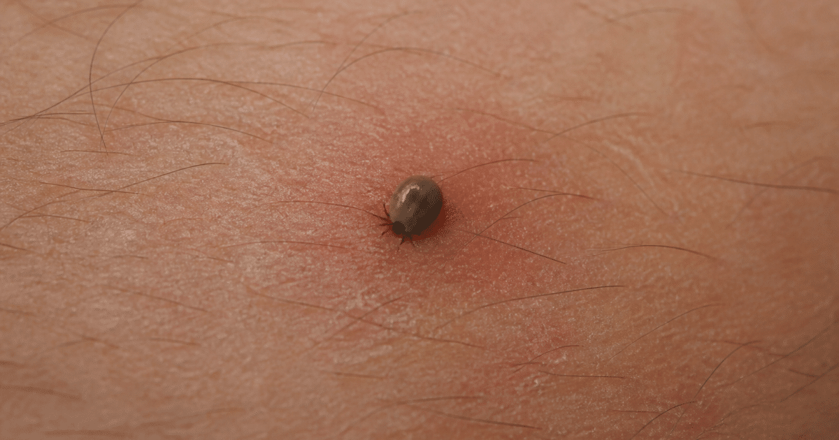 Tique enfoncee dans peau humaine, corps gris attache fermement